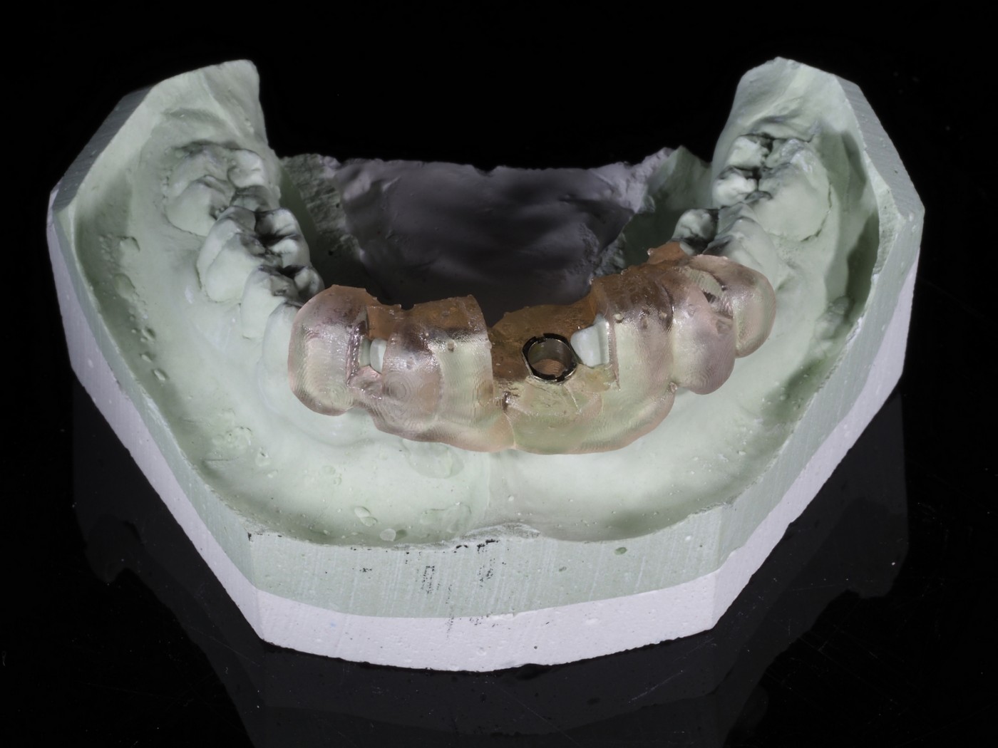 Implanturi ghidate chirurgical in clinica IMPLANTOART