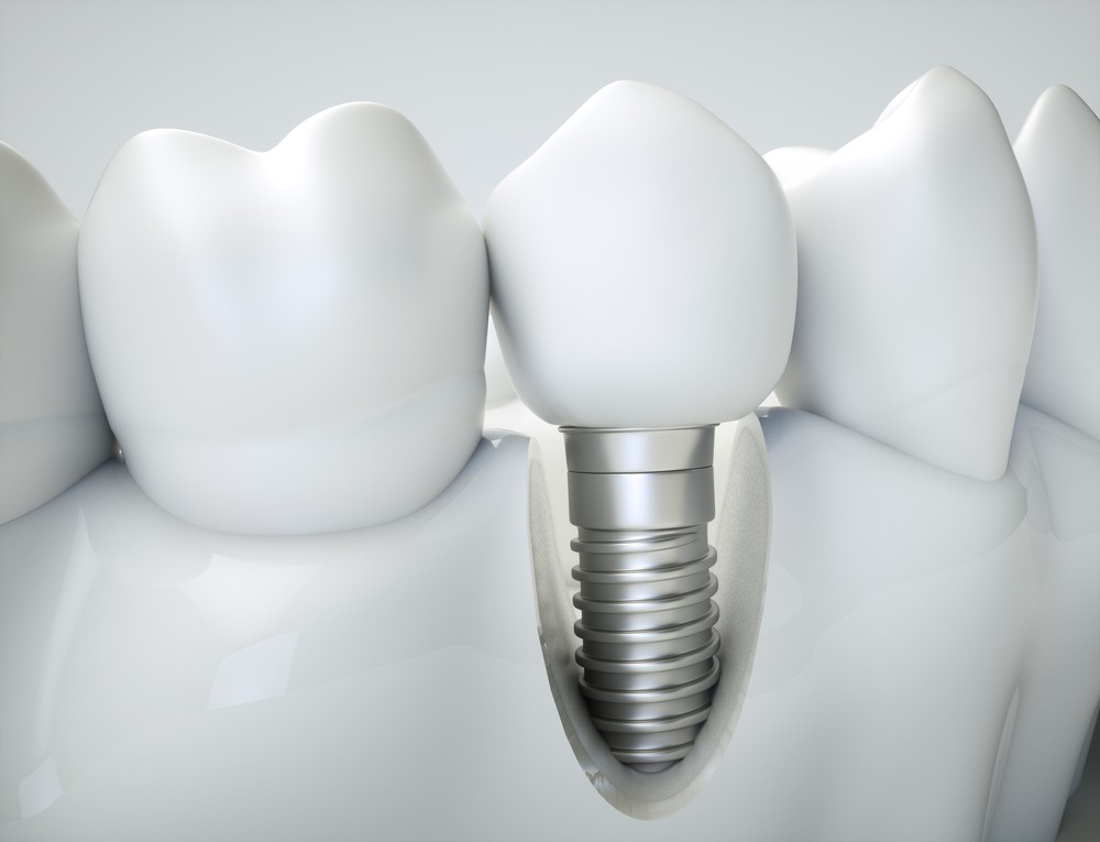 implant dentar galati, clinica stomatologica galati, clinica stomatologica implantoart