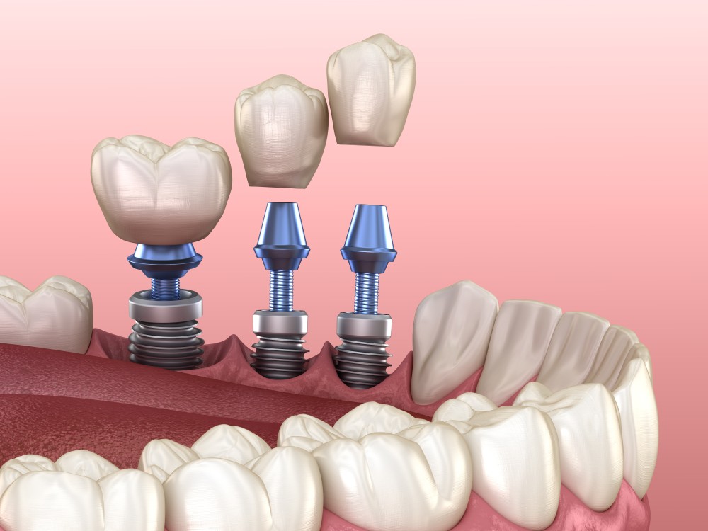 implant dentar galati, clinica stomatologica implantoart galati
