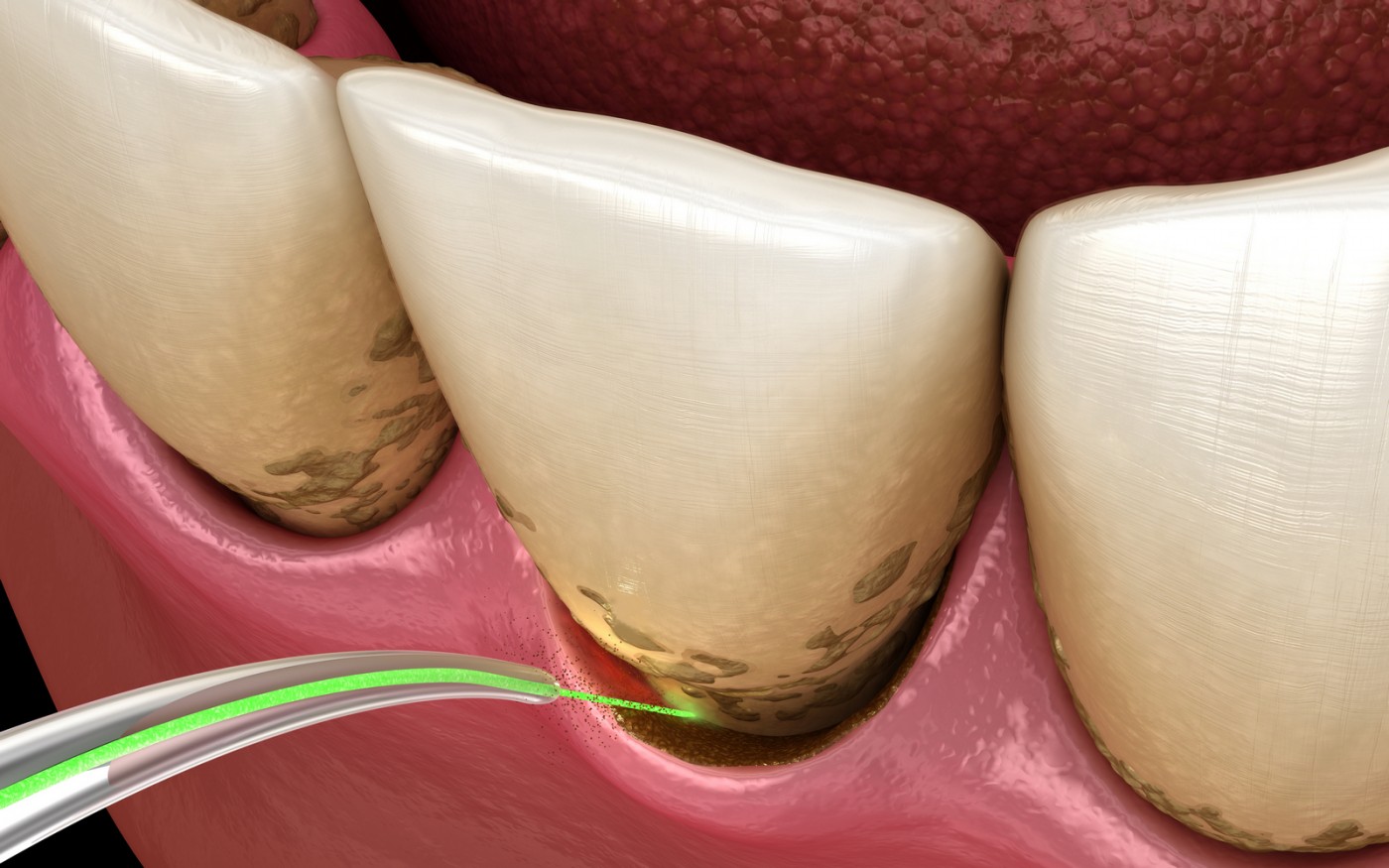 Tratament laser parodontoză Galați - Implantoart Dental Center