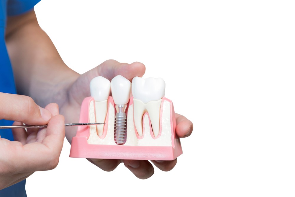 implant dentar, implant dentar galati, clinica stomatologica implantoart