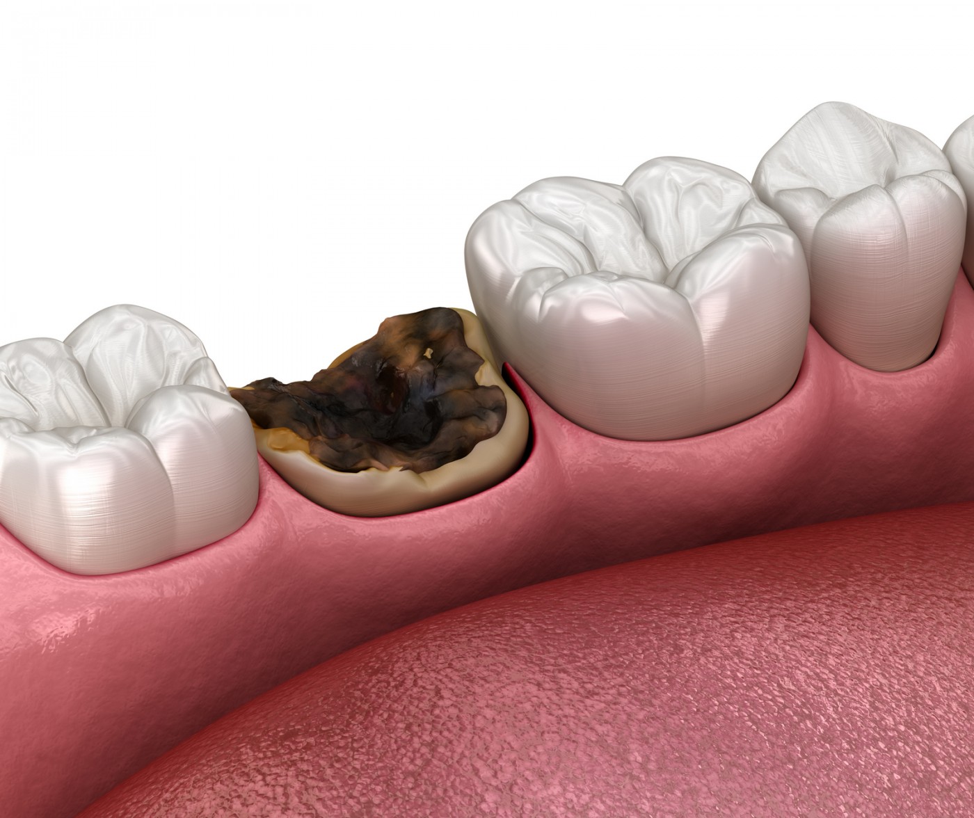 Solutii moderne de chirurgie dentara - Implantoart