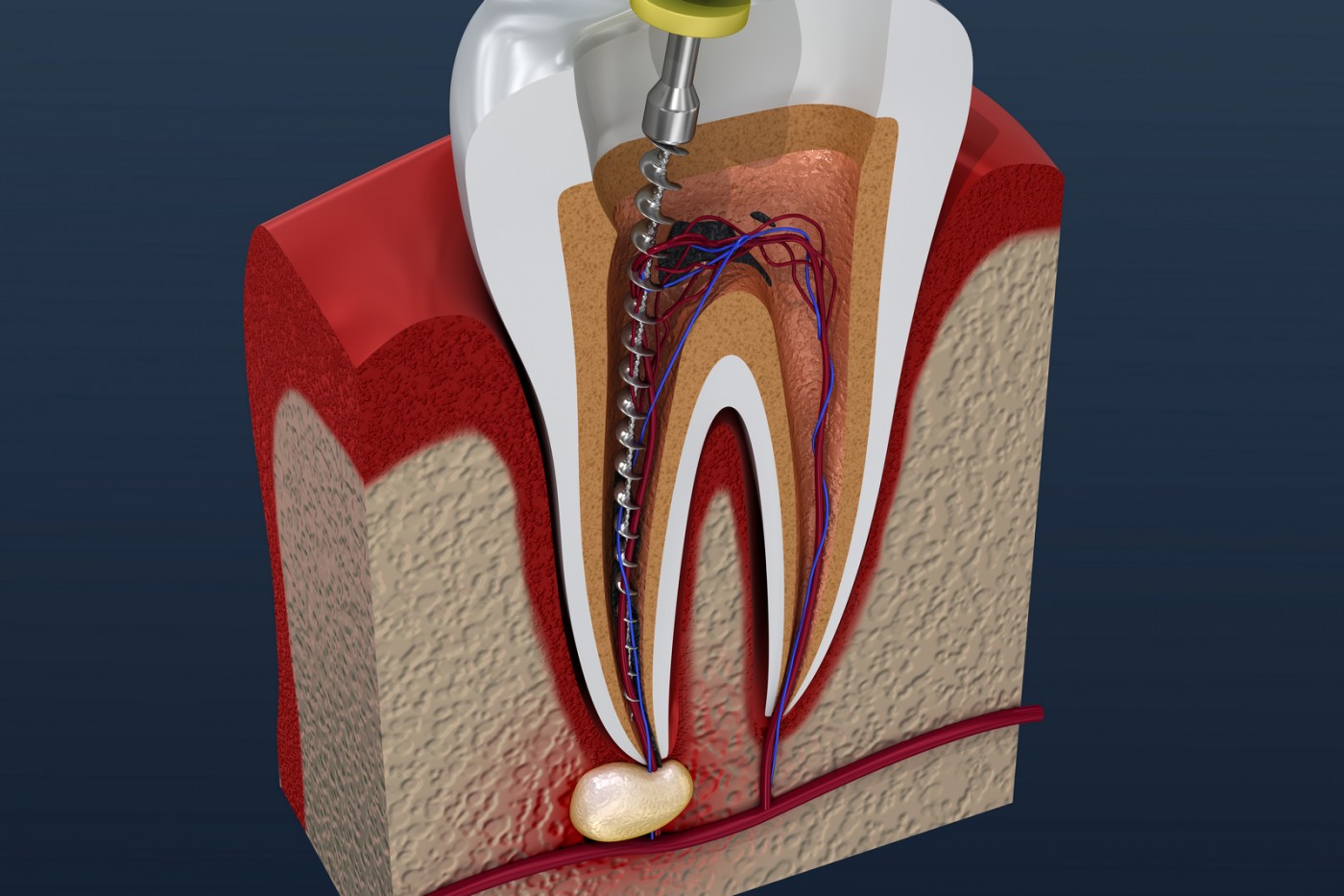 Endodonție Galați - Clinica Implantoart