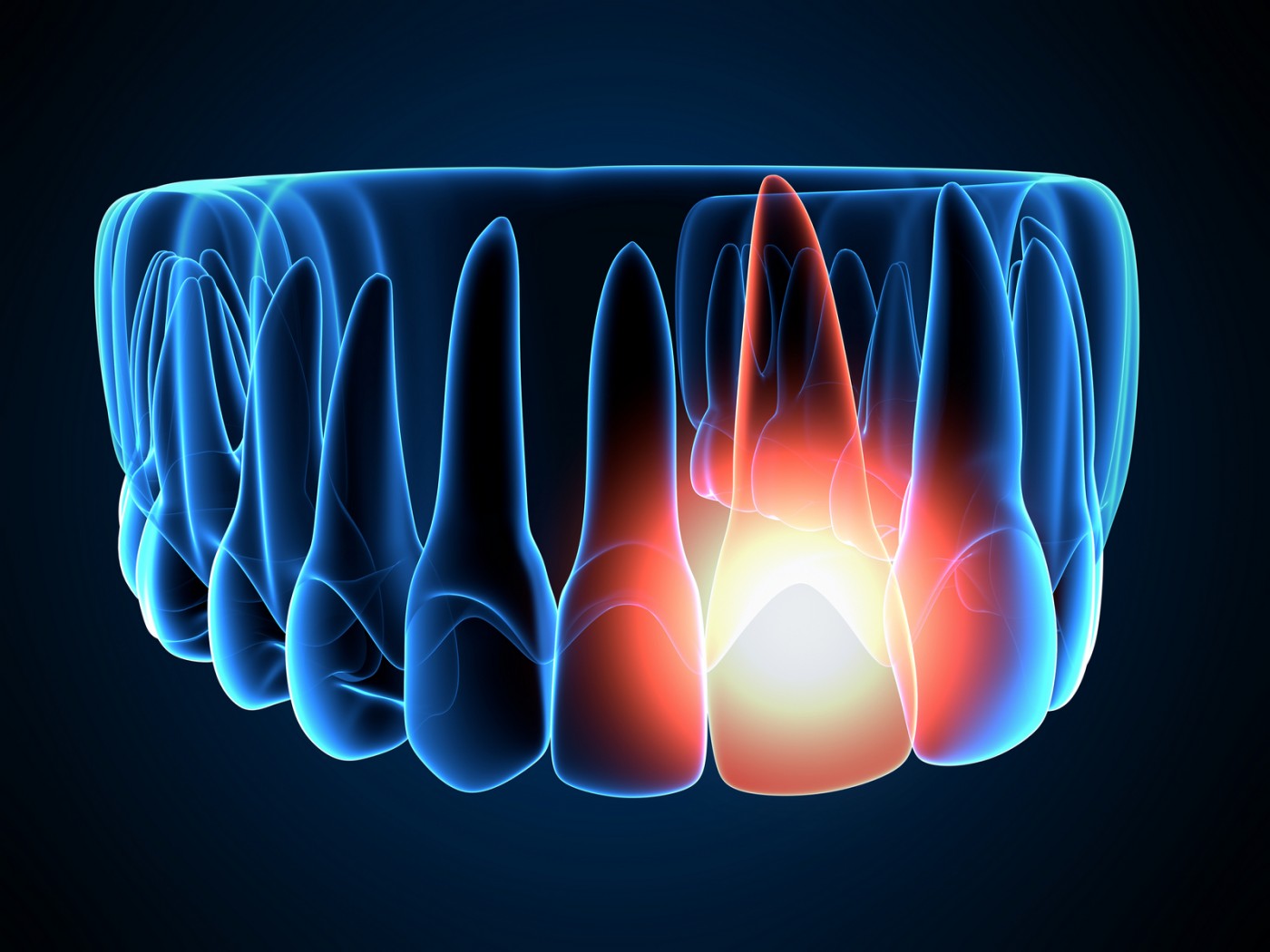 Infectii dentare tratate la Implantoart